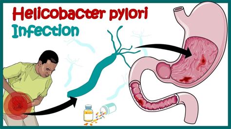 HELICOBACTER PYLORI INFECTION (H. PYLORI INFECTION) – The African Doctor