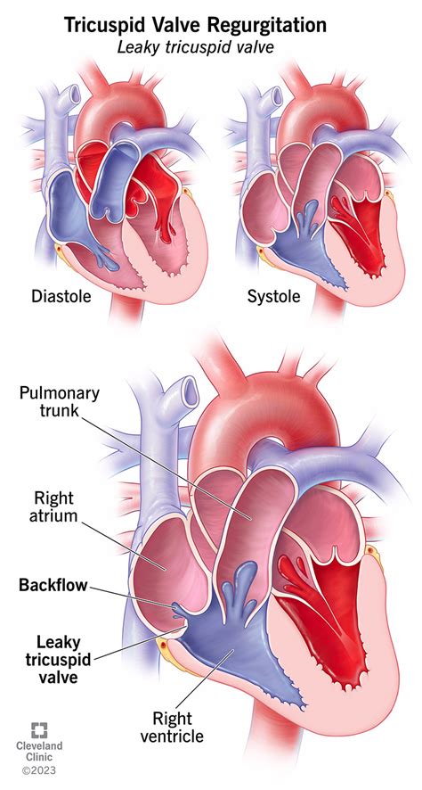 Tricuspid Valve Regurgitation: Symptoms & Treatment