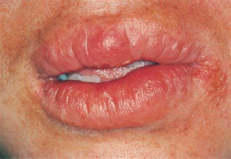 dentalaka: Lesions affecting Lips- Oral Medicine Lecture