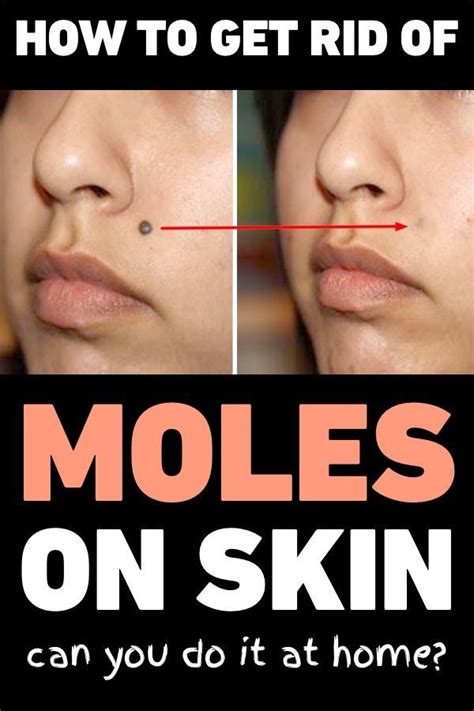 How To Get Rid Of Moles On Skin – Can You Do It At Home? | Skin moles ...