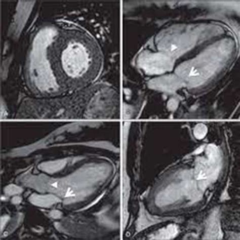 What is the Procedure of a Cardiac MRI?