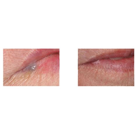 Lip Hemangioma Gallery - Before and After Treatment Images