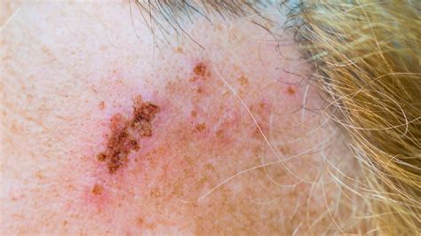 Shingles Scabs: Treatment and Self-Care