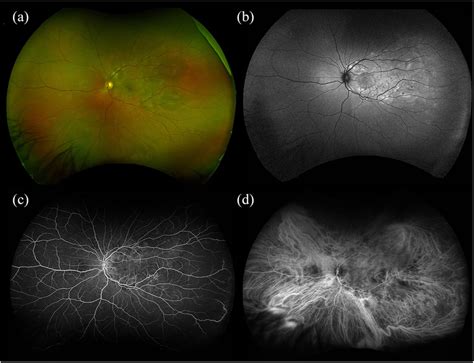 Vogt–Koyanagi–Harada disease: (a) Optos color fundus SLO displays ...