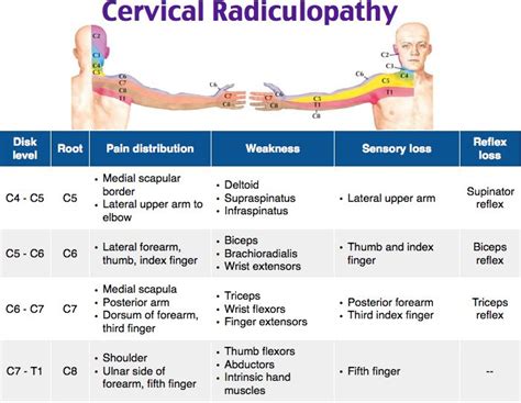 cervical spondylosis rosh - Google Search | Cervical radiculopathy, Radiculopathy, Cervical ...