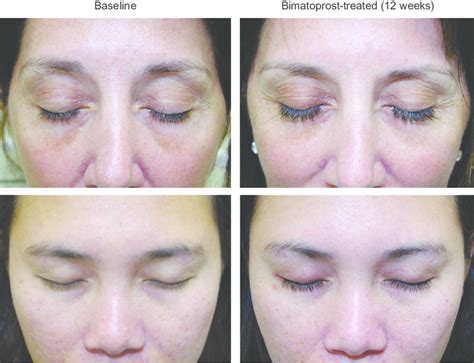 Bimatoprost Vs Latanoprost For Eyelash Growth: Which Is Better For You?