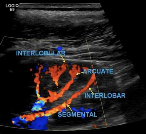 Renal Transplant Duplex Protocol – Sonographic Tendencies