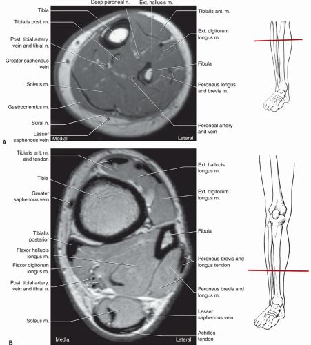 Foot Muscles Mri / MRI IN FOOT PAIN - tohtoha