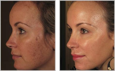 BBL Facial Rejuvenation Treatment - Coyle Institute