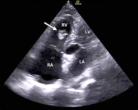 Cureus | Right Heart Thrombus in Transit Diagnosed With Focused Cardiac ...