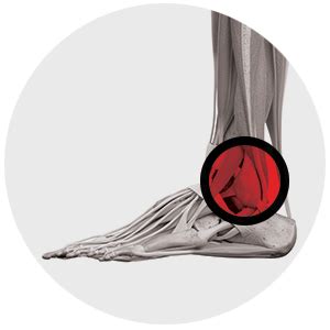 Ankle Instability - Rao