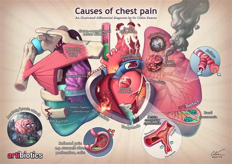 Causes of chest pain by cilein on DeviantArt