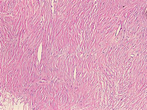 Fibroma