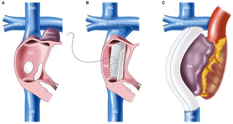 Various techniques of the Fontan procedure. (A) Atriopulmonary ...