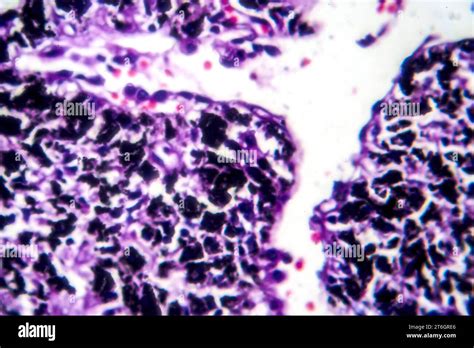 Photomicrograph of smoker's lung, revealing characteristic changes and ...