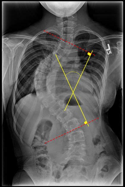 Cobb angle | Radiology Reference Article | Radiopaedia.org Radiology ...