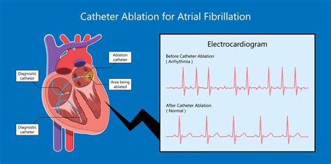 Atrial Fibrillation Specialist - New Port Richey, FL: Satish ...