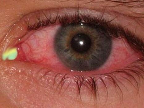 👉 Mucus in Eye - Types, Pictures, Home Remedies, Yellow Mucus (November 2021)