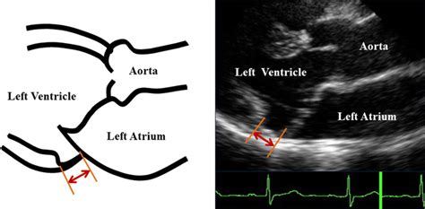 The analysis of mitral annular disjunction detected by echocardiography and comparison with ...