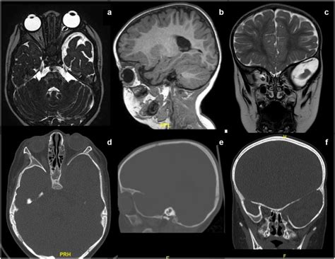 Case of a 3.5-year-old boy referred for a sphenoid wing dysplasia due ...