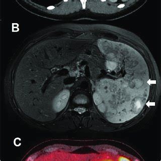 A. Contrast-enhanced tomodensitometry showing multiple collections. B.... | Download Scientific ...