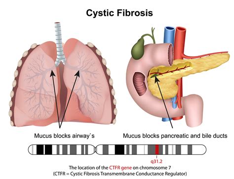 Fibrosis Of The Breast Causes Symptoms Diagnosis Treatment | My XXX Hot Girl