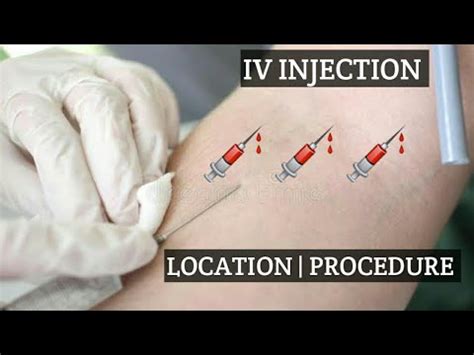 Intravenous injection site| location |intravenous injection technique ...