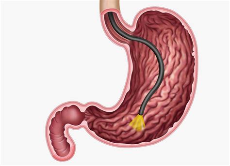 Gastroscopy | Oxford Gut and Liver