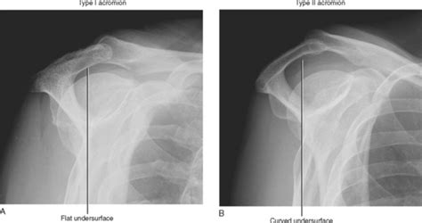 Supraspinatus Outlet View Shoulder X Ray | SEMA Data Co-op