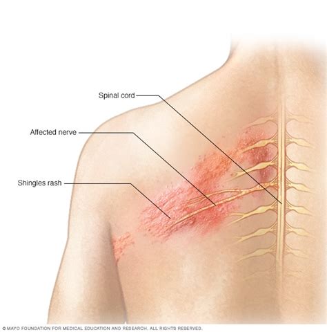 Shingles - Symptoms and causes - Mayo Clinic