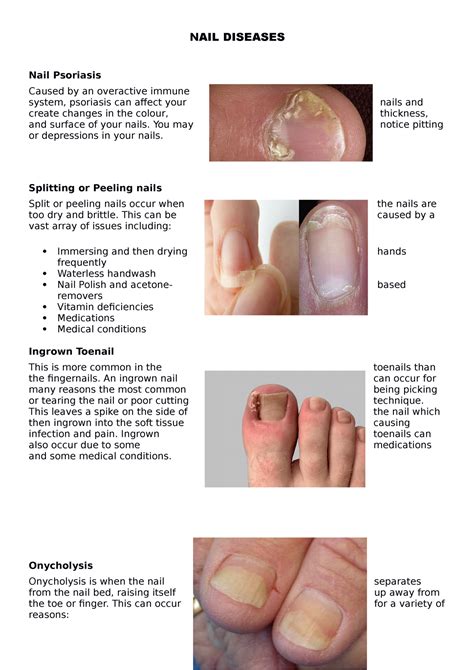 Nail Psoriasis: What It Is, Causes, Nail Pitting, Treatment, 53% OFF