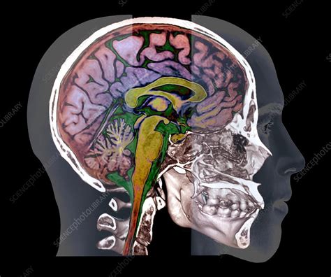 Human skull and brain, CT and MRI scans - Stock Image - C048/0696 ...