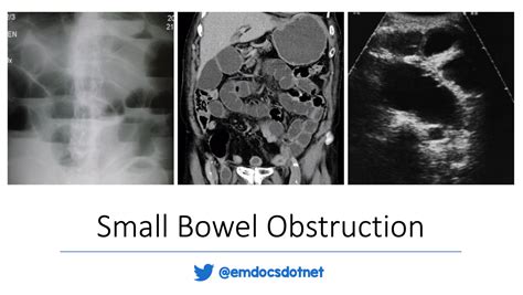 emDOCs.net – Emergency Medicine EducationemDOCs Podcast – Episode 29: Small Bowel Obstruction ...