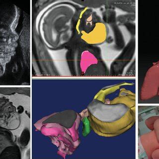 Fetus with alobar holoprosencephaly with a proboscis at 26 weeks ...