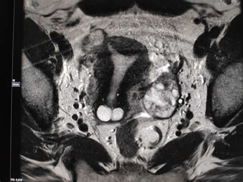 Incidental arcuate uterus on pelvic MRI with broad fundal indentation ...