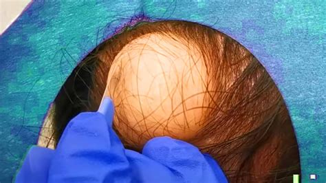 Giant Scalp Cyst Popping! DB's Pilar Cyst Removal!