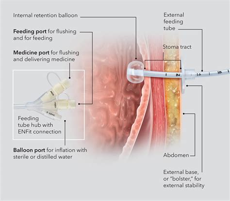 Gastrostomy Tubes (G Tube) Children's Hospital Of, 46% OFF