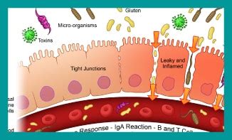 Treatment for Leaky Gut - Guardian featured Harley Street IBS Clinic