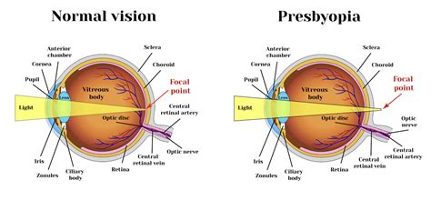 Monovision LASIK (How it Works, Ideal Candidates & FAQs)