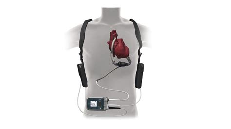 Left Ventricular Assist Device (LVAD) | WVU Heart and Vascular Institute