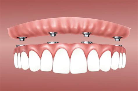 Snap-In Dentures | Implants | Types | Memphis | Hernando