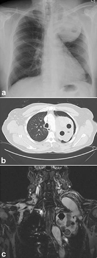 [PDF] Late extrusion of pulmonary plombage outside the thoracic cavity ...