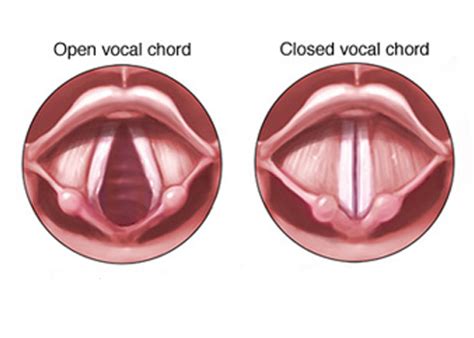 Vocal Fold Paralysis / Weakness | ENT Kerimis Clinic Ears,Nose, and Throat in Limassol Cyprus