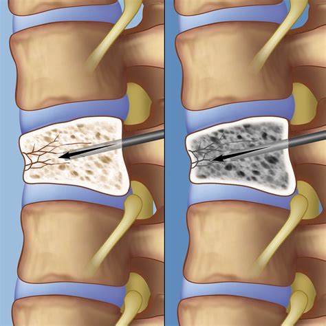 Vertebrae Disc Fracture at Dorothy Nichols blog