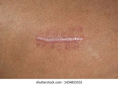 Puncture Wound Images, Stock Photos & Vectors | Shutterstock