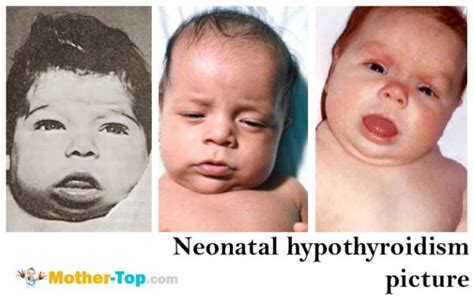 Hipotiroidismo Neonatal