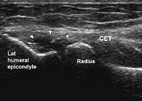 Extensor Tendon Tear