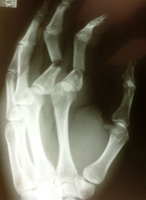 Broken Finger Treatment in Raleigh, NC - Raleigh Hand Center | Raleigh ...