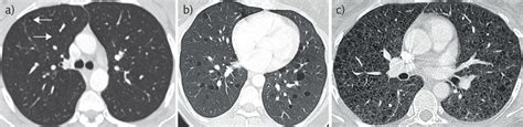 Lymphangioleiomyomatosis: a clinical review | European Respiratory Society