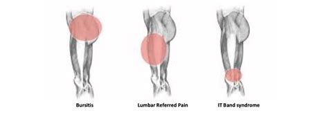 Lateral Thigh Muscles